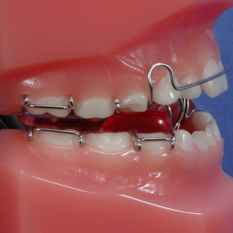 twin block to close an anterior open bite with spinner & tongue