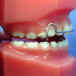 bionator to close 编 号 | 3012             欲知详细说明请参考  "